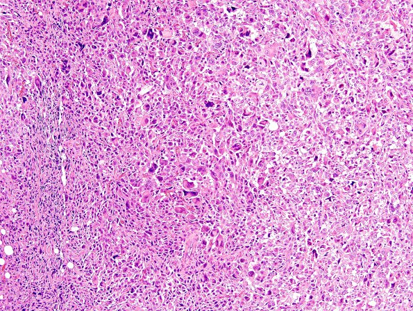 18B2 MPNST, plex NF in NF1, epitheloid (Case 18) H&E 1