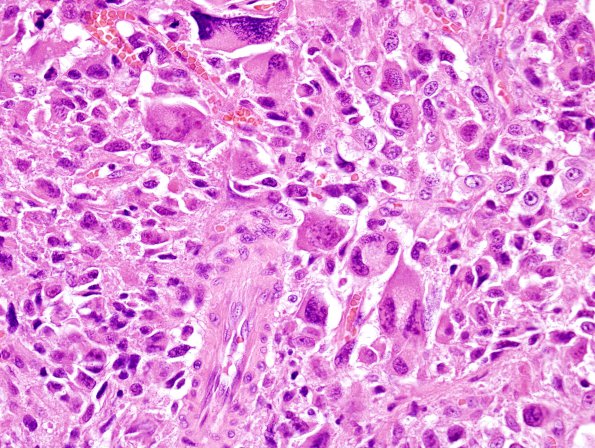 18B3 MPNST, plex NF in NF1, epitheloid (Case 18) H&E 4