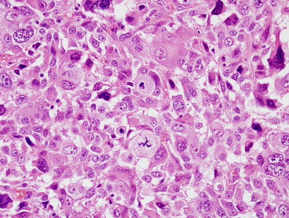 18B4 MPNST, plex NF in NF1, epitheloid (Case 18) H&E 5