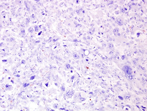 18C MPNST, plex NF in NF1, epitheloid (Case 18) S100 1