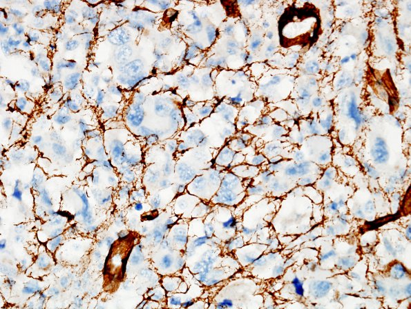 18D2 MPNST, plex NF in NF1, epitheloid (Case 18) Coll IV 1