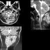 1A1 MPNST, low grade (Case 1) MR T2 - Copy - Copy