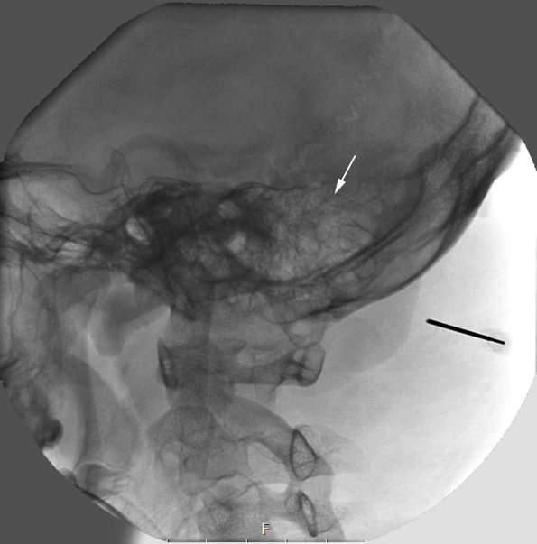 1A2 MPNST, low grade in plexiform (Case 1) Fluorogram - Copy