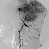 1A3 MPNST, low grade in plexiform (Case 1) Angiogram New 2 cop - Copy