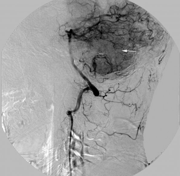 1A3 MPNST, low grade in plexiform (Case 1) Angiogram New 2 cop - Copy