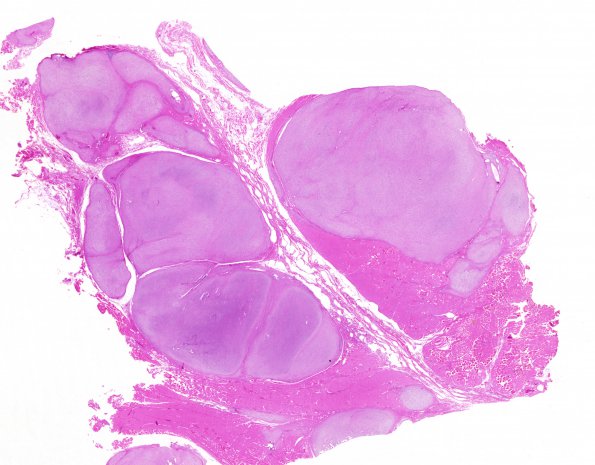 1C1 MPNST (Case 1) whole mount 1