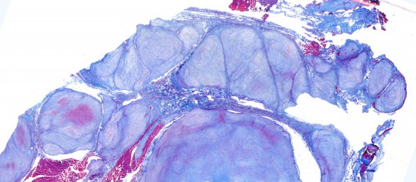 1F1 MPNST (Case 1) trichrome 1