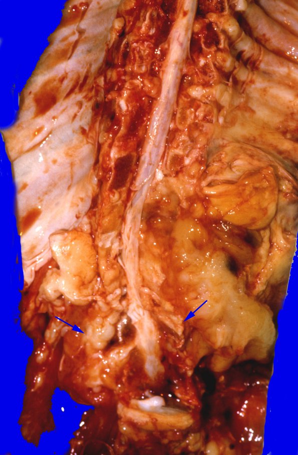 20A1 Neurofibromatosis 1 (Case 20) 1 copy