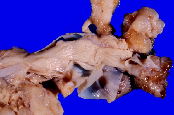 20A4 Neurofibromatosis 1 (Case 20) 5