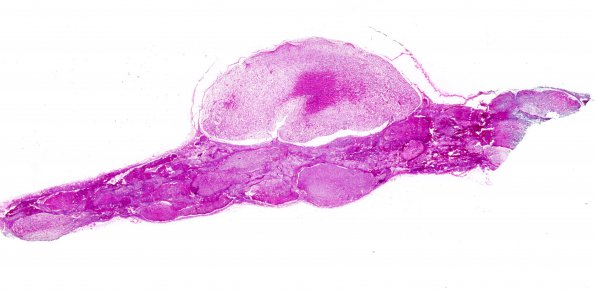 20B2 Neurofibromatosis 1 (Case 20) H&E whole mount