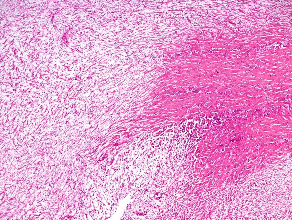 20B3 Neurofibromatosis 1 (Case 20) Neurofibroma area A H&E 3.jpg