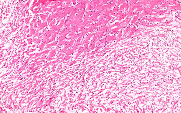 20B4 Neurofibromatosis 1 (Case 20) Neurofibroma area A H&E 10X