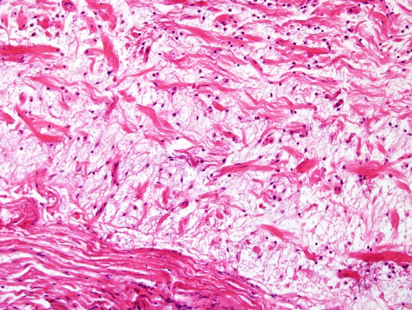 20B5 Neurofibromatosis 1 (Case 20) Neurofibroma area A H&E 4.jpg