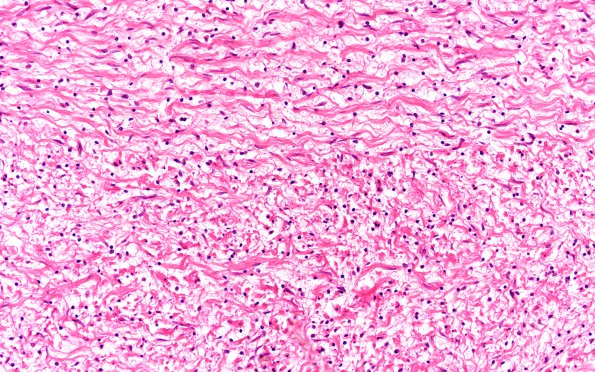 20B6 Neurofibromatosis 1 (Case 20) Neurofibroma area A H&E 20X