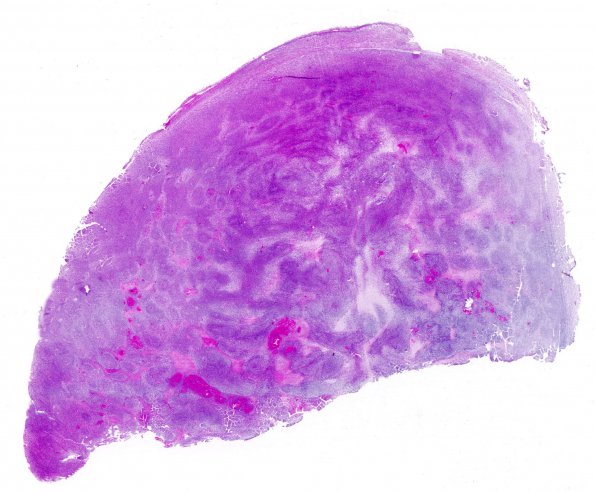 20C1 Neurofibromatosis 1 (Case 20) MPNST Area H&E whole mount 2