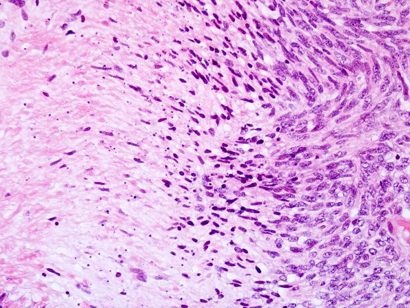 20C3 Neurofibromatosis 1 (Case 20) MPNST A H&E 4.jpg