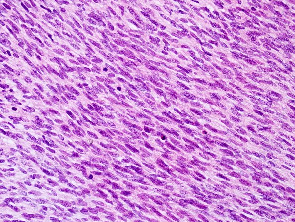 20C4 Neurofibromatosis 1 (Case 20) MPNST A H&E 5.jpg