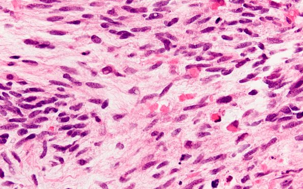 4A3 MPNST (Case 4) rhabdomyoblast differentiation H&E