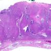 5A1 Metastases, MPNST (Case 5) R WM