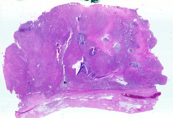 5A1 Metastases, MPNST (Case 5) R WM