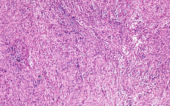 5A2 Metastases, MPNST (Case 5) 7 R 10X