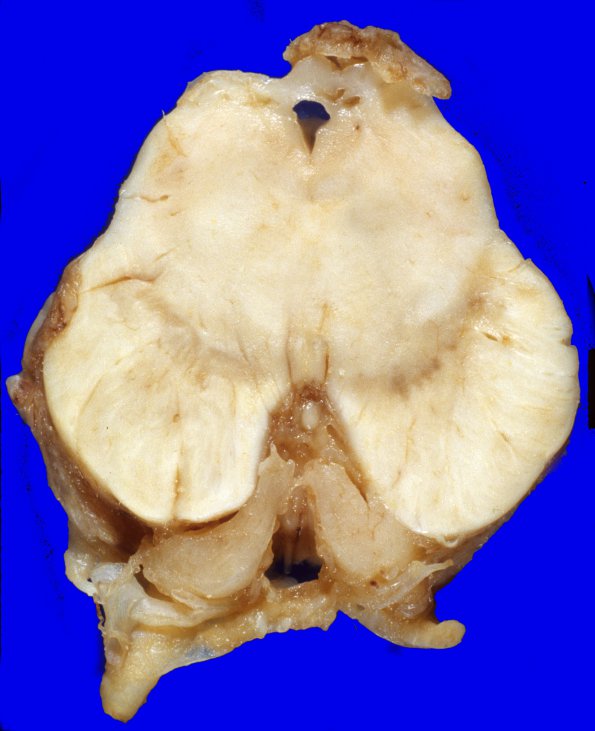 5B2 Metastases, MPNST (Case 5) 6