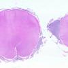 5B3 Metastases, MPNST (Case 5) M WM