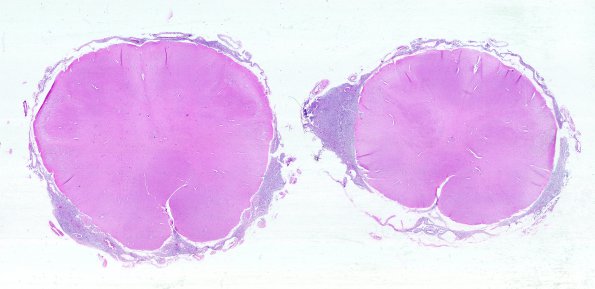 5B3 Metastases, MPNST (Case 5) M WM