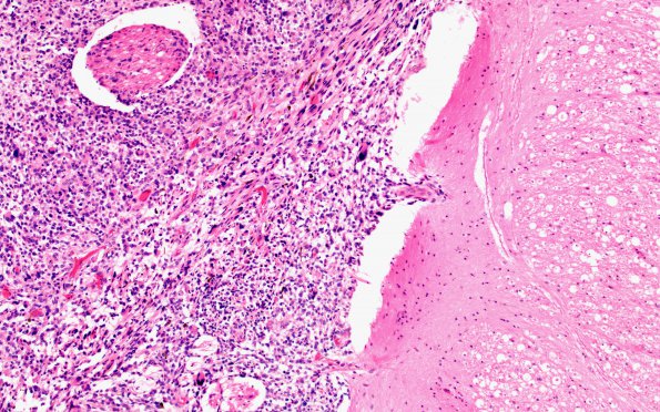 5B4 Metastases, MPNST (Case 5) 7 M 10X