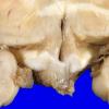 5C1 Metastases (Case 5), MPNST 2