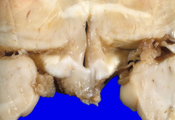 5C1 Metastases (Case 5), MPNST 2