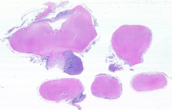 5C2 Metastases, MPNST (Case 5) J WM