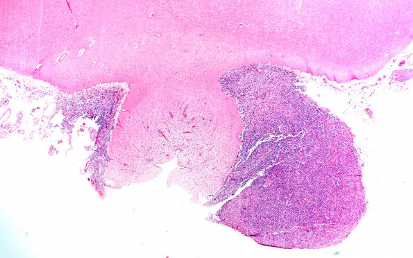 5C3 Metastases, MPNST (Case 5) 7 J 2X