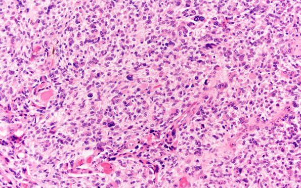 5C4 Metastases, MPNST (Case 5) 7 J 20X