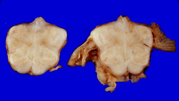 5D Metastases (Case 5) MPNST 3