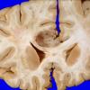 5E1 Metastases, MPNST (Case 5) 7