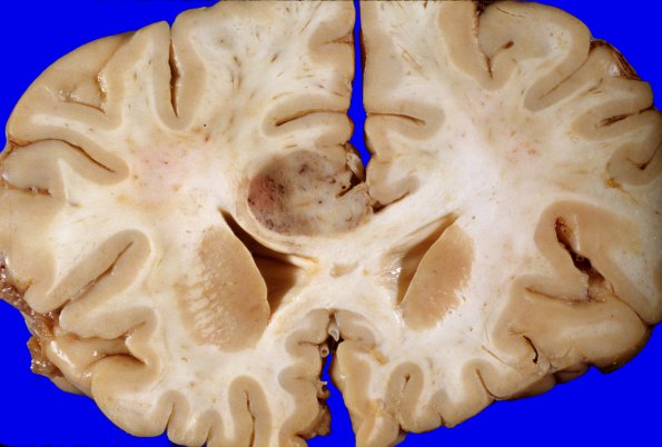 5E1 Metastases, MPNST (Case 5) 7