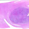 5E2 Metastases, MPNST (Case 5) 7