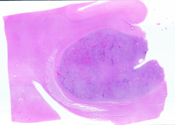 5E2 Metastases, MPNST (Case 5) 7