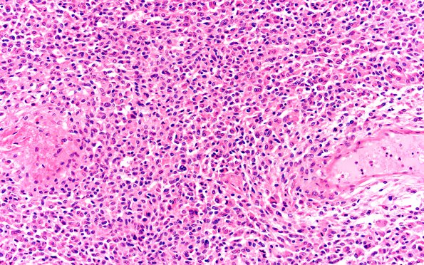 5E3 Metastases, MPNST (Case 5) 7 H 20X