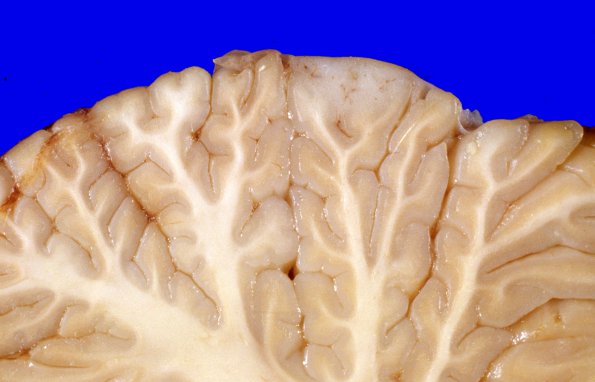 5G Metastases, MPNST (Case 5) 9 1a