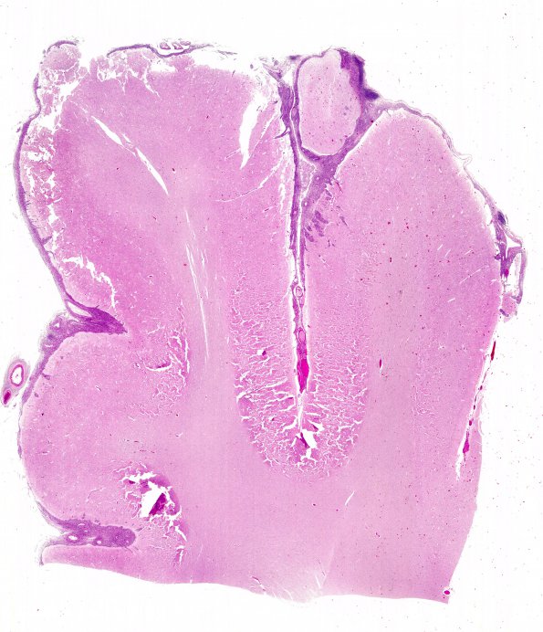 6B1 MPNST (Case 6, thanks Szymanski & Hurth) H&E B4 WM