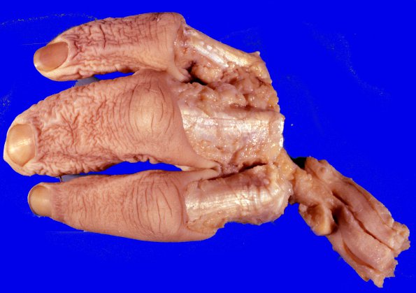 7J Neurofibroma, plexiform (Case 7J)