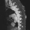 8A MPNST (Case 8) STIR - Copy