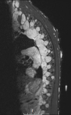 8A MPNST (Case 8) STIR - Copy