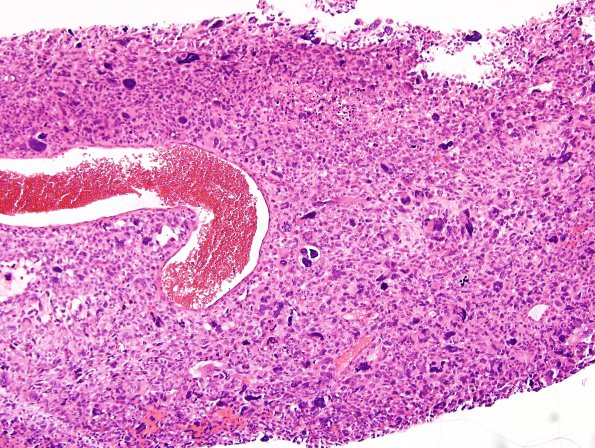 8B1 MPNST (Case 8) H&E 10X.jpg