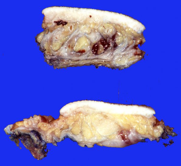 10A Neurofibroma, cutaneous, diffuse (Case 10)