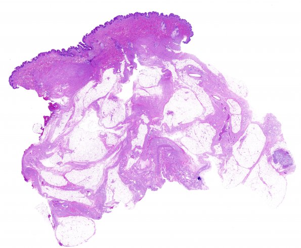 10B1 Neurofibroma, cutaneous, diffuse (Case 10) H&E whole mount