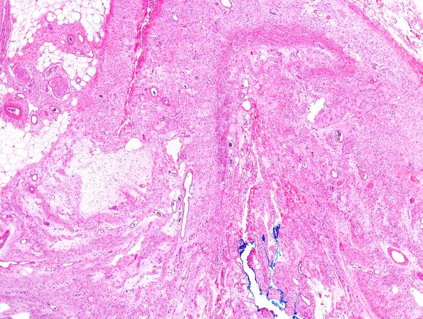 10B2 Neurofibroma, cutaneous, Meissner's (Case 10) H&E 2.jpg