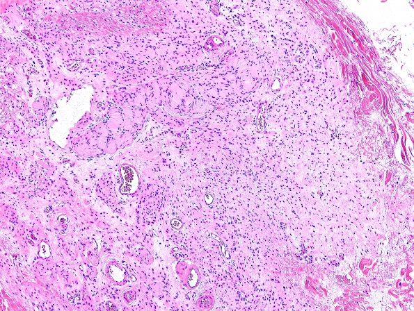 10B3 Neurofibroma, cutaneous, Meissner's (Case 10) H&E 5.jpg